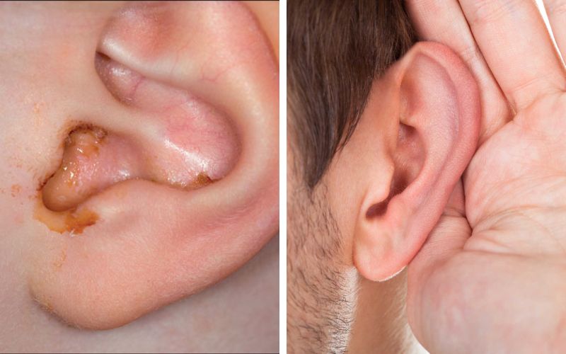 Nhiễm trùng tai giữa